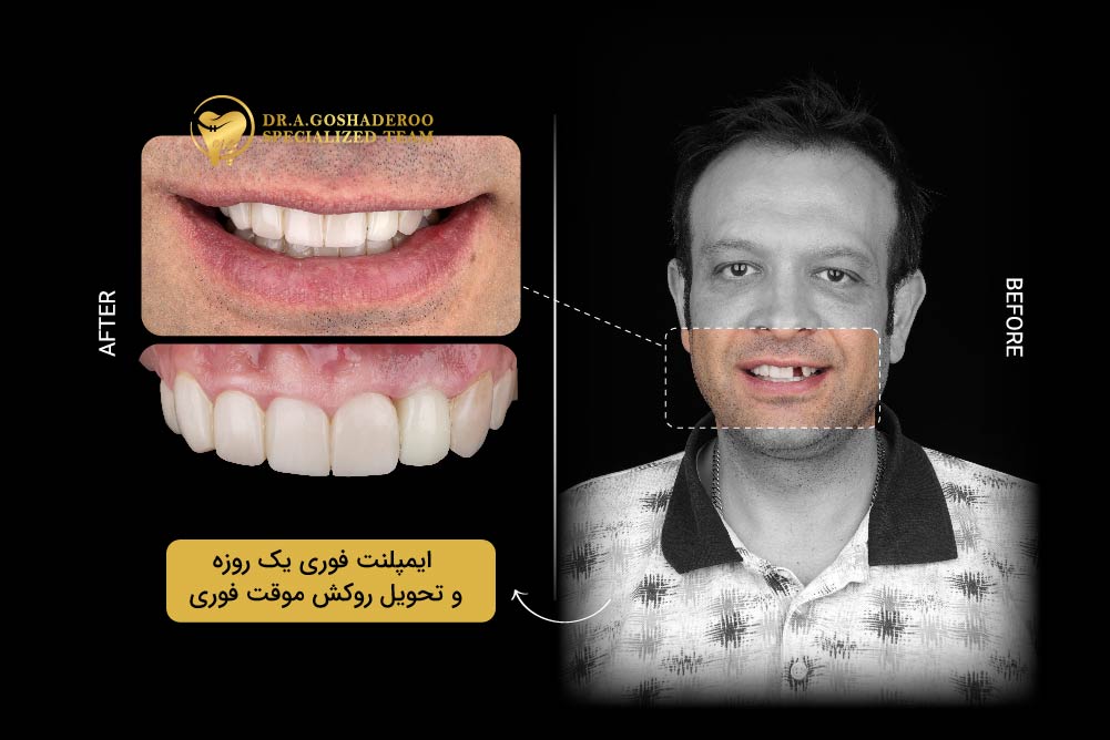 چرا انتخاب متخصص و مرکز مناسب برای ایمپلنت اهمیت دارد؟